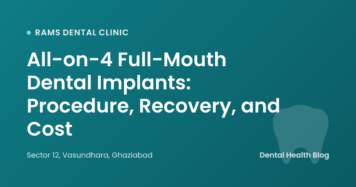 All-on-4 Full-Mouth Dental Implants: Procedure, Recovery, and Cost