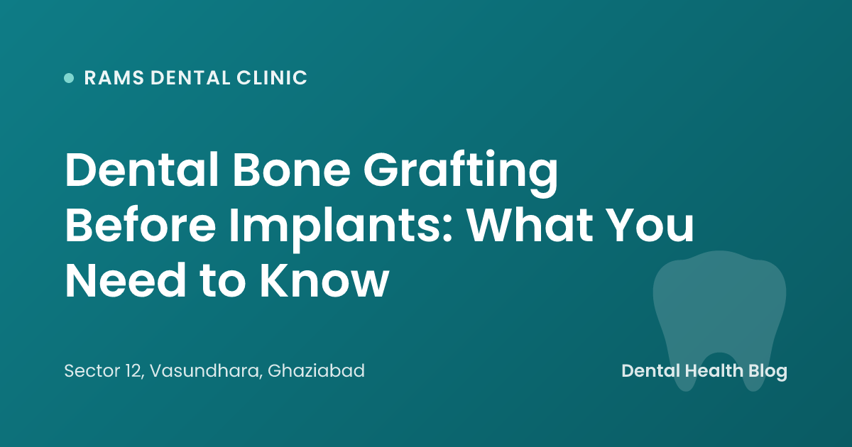 Dental Bone Grafting Before Implants: What You Need to Know