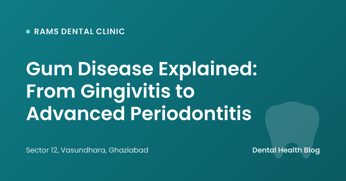 Gum Disease Explained: From Gingivitis to Advanced Periodontitis
