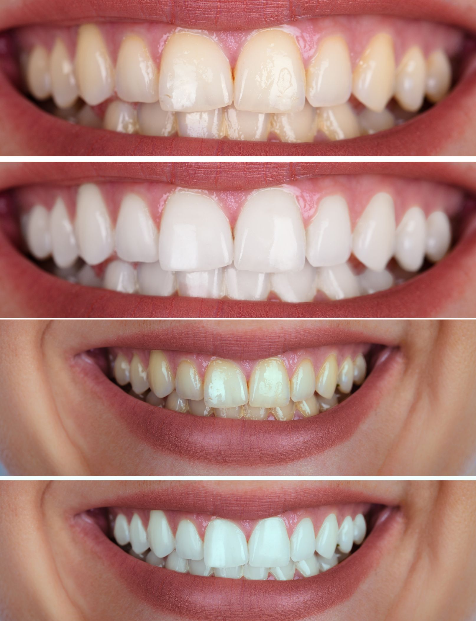 teeth whitening treatment in ghaziabad